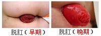 脱肛早晚期实拍图
