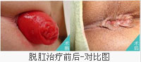 脱肛治疗前后对比图